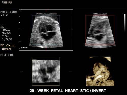 Clearvue650 29 Week Fetal Heart Lrg