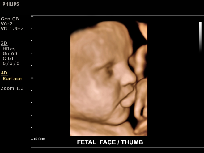 ClearVue 650 "Fetal face" 